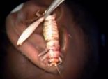 بالفيديو| أطباء يستخرجون حشرة ضخمة من أذن مريض بالهند