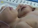 مستشفى بنها تعلن وفاة طفل المنوفية ذو الرأسين 