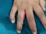 بالصور| نجاح جراحة تجميلية لأصابع ملتصقة لطفلة في مستشفى رأس سدر