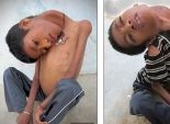 بالصور| طفل يعاني من مرض نادر عجز 50 طبيبا حول العالم عن تشخيصه