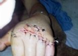  في جراحة نادرة بطوارئ المنصورة.. إعادة توصيل ثلاثة أصابع لمريض بعد قطعها بسيف